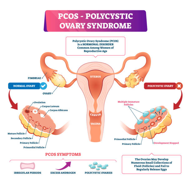 pcod treatment